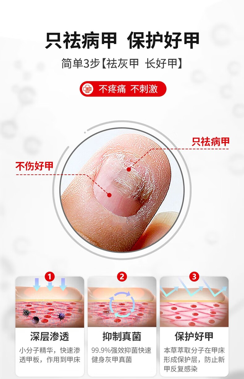 【不满意我买单】去除灰指甲中草药增厚灰指甲脱甲液专用抑菌液软甲膏甲沟灰指甲液