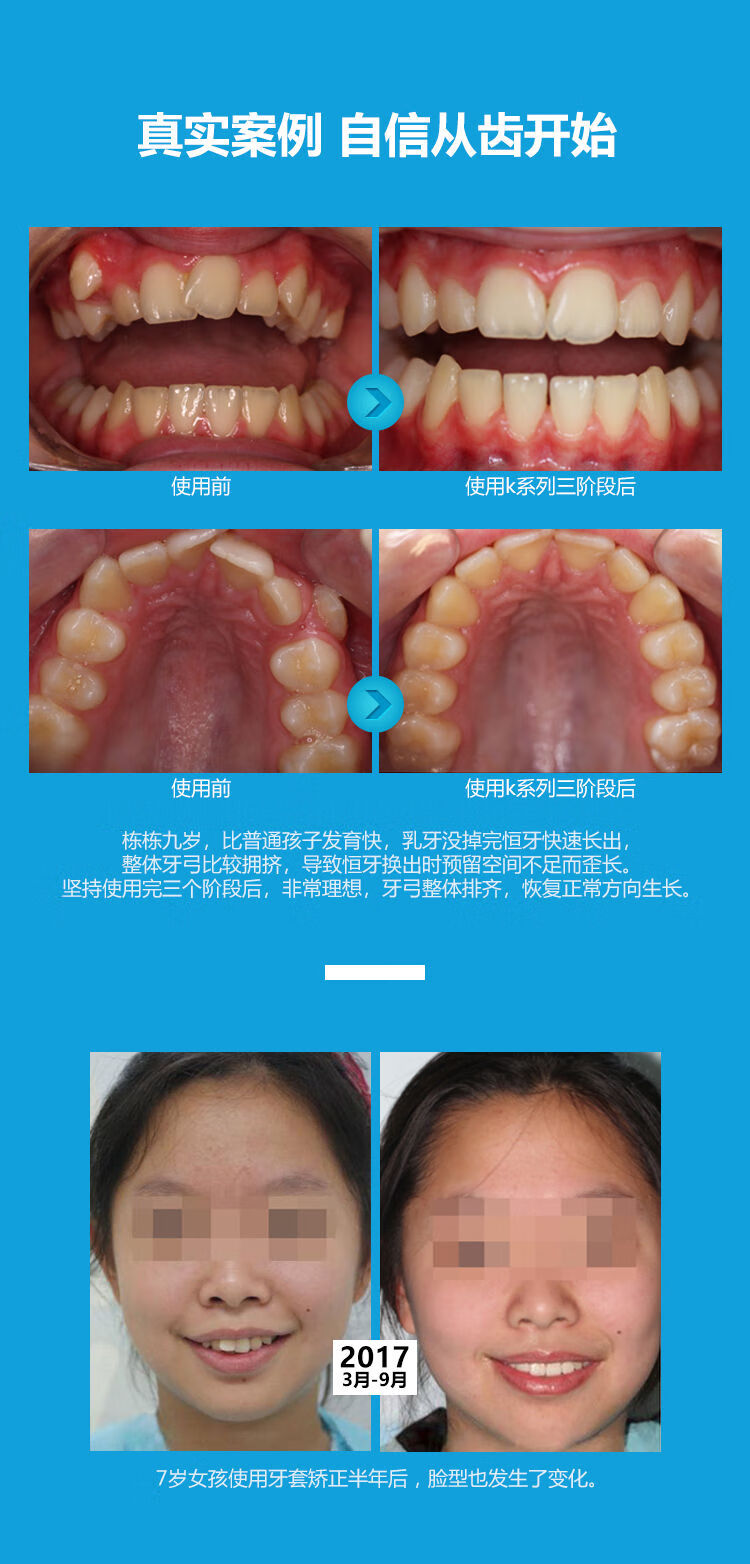 儿童mrc牙齿矫正器纠正口呼吸龅牙深覆合地包天k1澳洲