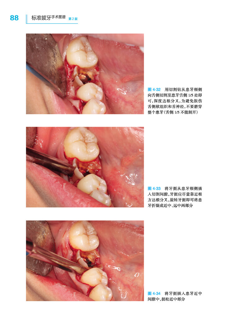 【现货】标准拔牙手术图谱第2版第二版 胡开进 阻生齿智齿牙拔除术书