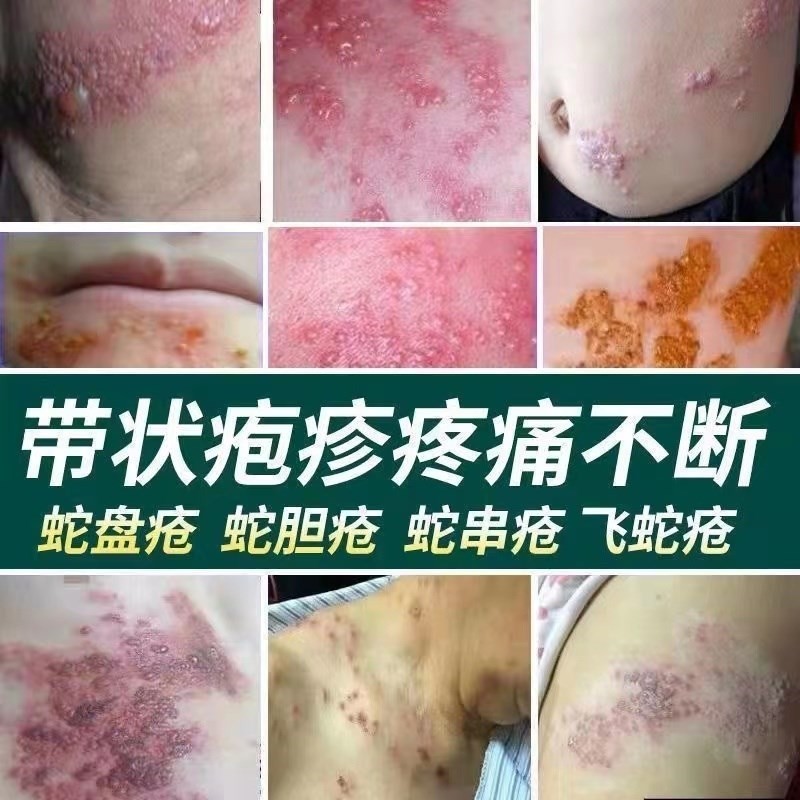 言蛇丹必康红颜a型蛇丹加b型带状康带状i疱ii疹清蛇缠腰蛇盘i疮aa1盒