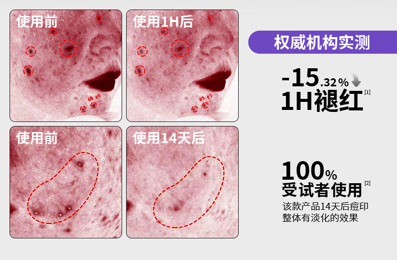 DRDM祛痘精华液水杨酸抗痘去闭口粉刺修护痘肌原液控油淡化痘印 20ml