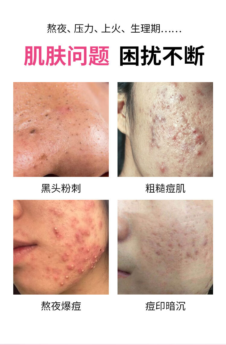 翼颜15%壬二酸凝胶软膏祛痘精华凝露水杨酸唑去淡化黑头粉刺痘印乳膏 壬二酸修护凝胶1盒
