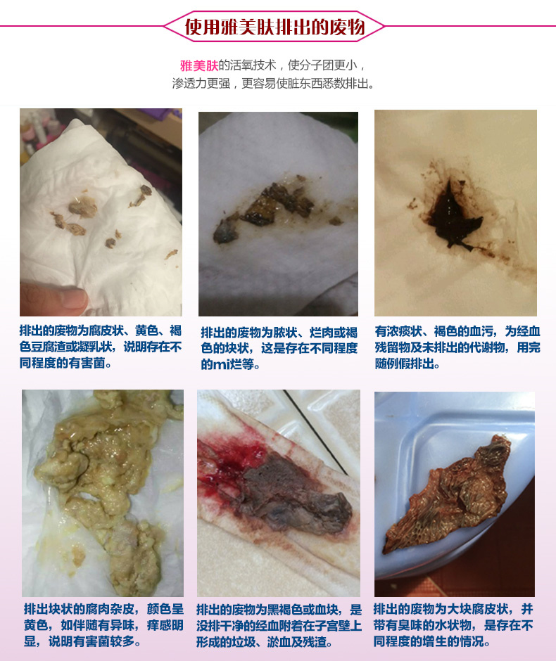 雅美肤紧致缩阴抑菌凝胶私处护理轻重度宫颈瘙痒糜烂阴道内外阴炎白带