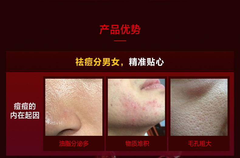 瓷肌（SPA CHNSKIN） 净颜清痘套装(男女士中度)淡化痘印控油补水收缩毛孔深层清洁护肤品学生