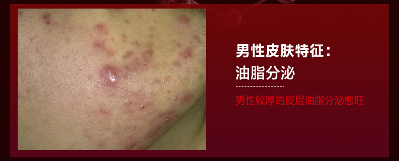瓷肌（SPA CHNSKIN） 净颜清痘套装(男女士中度)淡化痘印控油补水收缩毛孔深层清洁护肤品学生