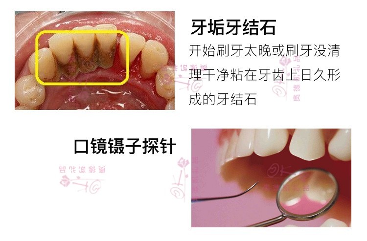 斯宝路 牙结石去除器 家用洗牙刮牙器洗清除牙渍牙垢剔牙工具 皮盒六