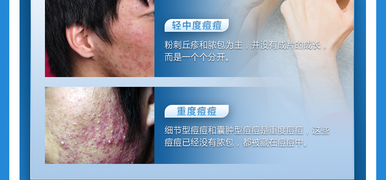 瓷肌（SPA CHNSKIN） 净颜清痘套装(男女士重度) 淡化痘印清洁控油收缩毛孔护肤品