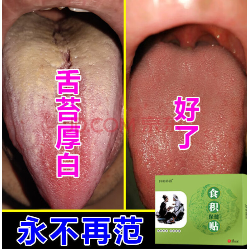 【可拔垠】湿气脾胃虚弱湿气重舌苔厚腻发白短无力乏力便稀食积贴