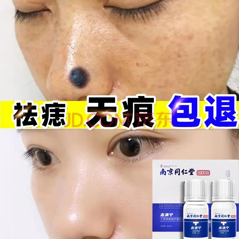 无痕点痣药水修复膏消痣液黑痣雀斑疣子痦子凸痣平瘊膏点痣灵 一盒装