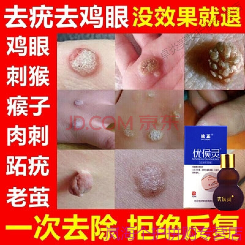 一抹就掉 去i疣产品去i疣灵扁平i疣足部去除i膏病