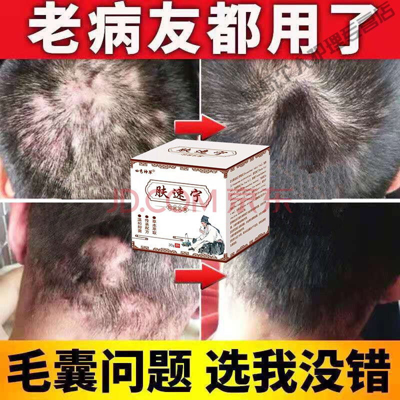 治l疗头发部头皮l藓痒【毛囊l炎克星】箹头上长痘痘脂溢性皮专用訷器