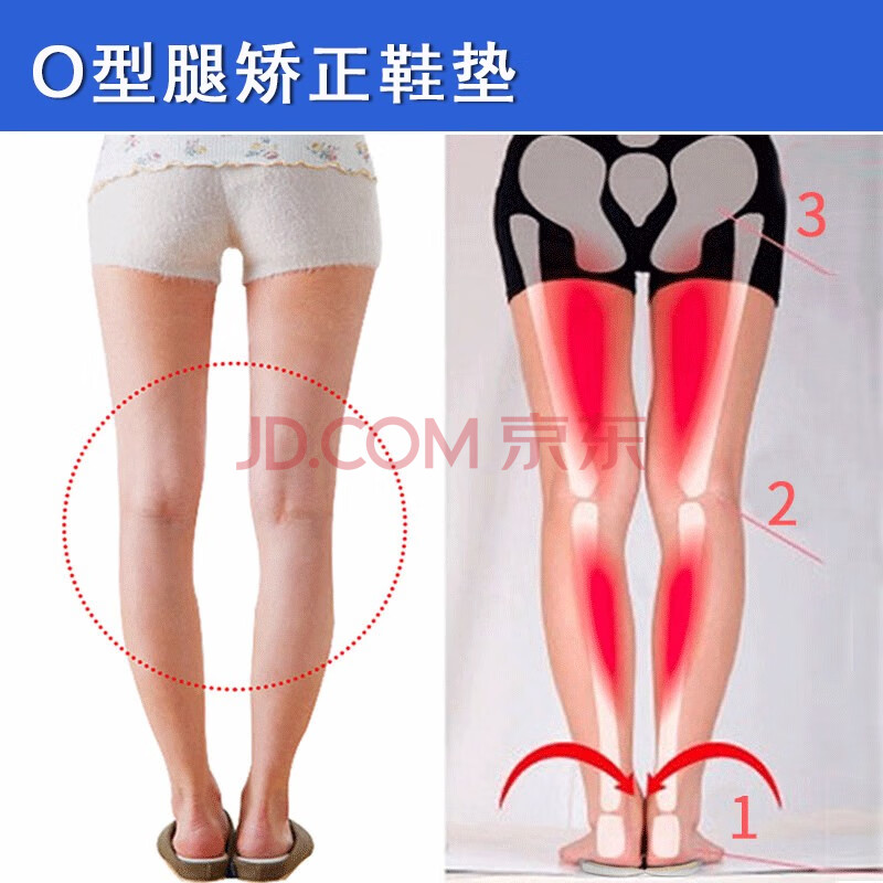 o型腿矫正鞋垫 螺旋腿萝卜腿美腿纠正腿型垫 外高内低垫外八字足内翻