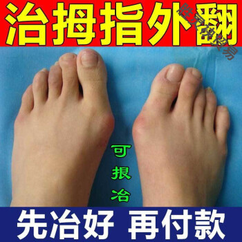 严重拇外翻【可拫冶】拇脚指外翻畸形矫正l器大脚骨拇趾重叠痛专l用