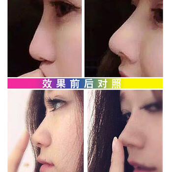 鼻翼高鼻梁器垫鼻子变挺瘦鼻鼻撑美鼻神器量大从优进品隐形器3对m码