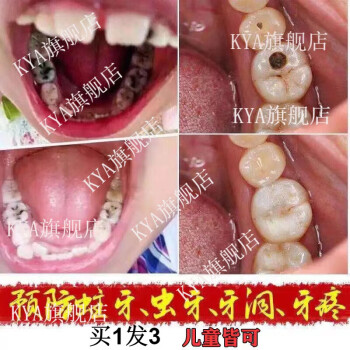 官方旗舰拓实牙舒喷剂牙龈肿痛牙y周炎特效上火蛀虫智齿发f炎立可3盒