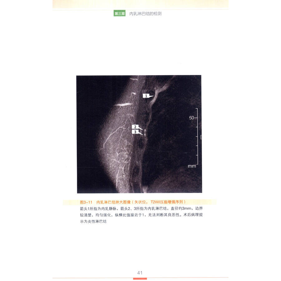 乳腺癌内乳淋巴结研究