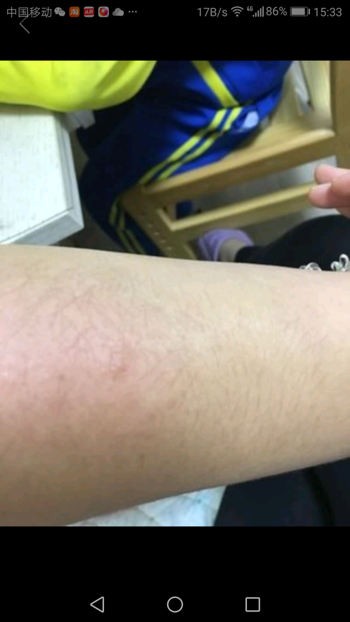 体股藓湿疹止痒无激素屁股廯膏外用皮肤瘙痒消疹汗斑花斑铜钱圆癣药王