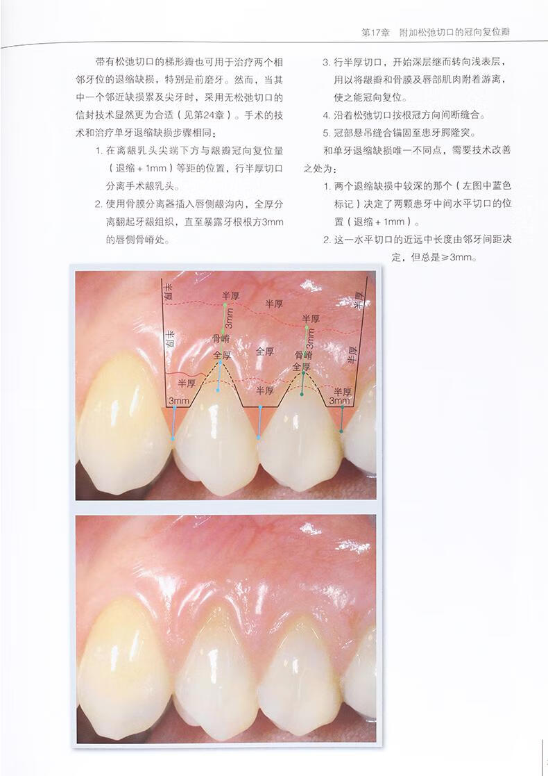 《正版 膜龈美学手术精要 牙周病口腔种植学口腔修复学书籍 牙龈退缩
