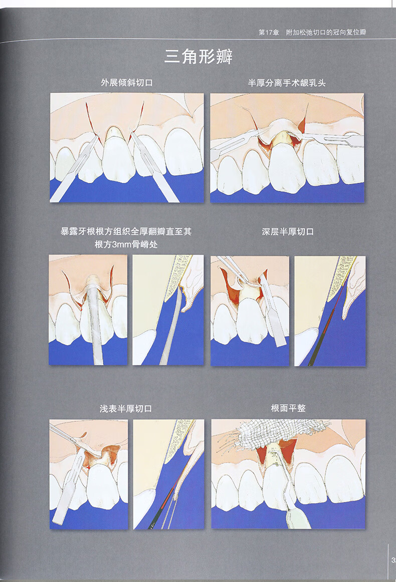 《正版 膜龈美学手术精要 牙周病口腔种植学口腔修复学书籍 牙龈退缩