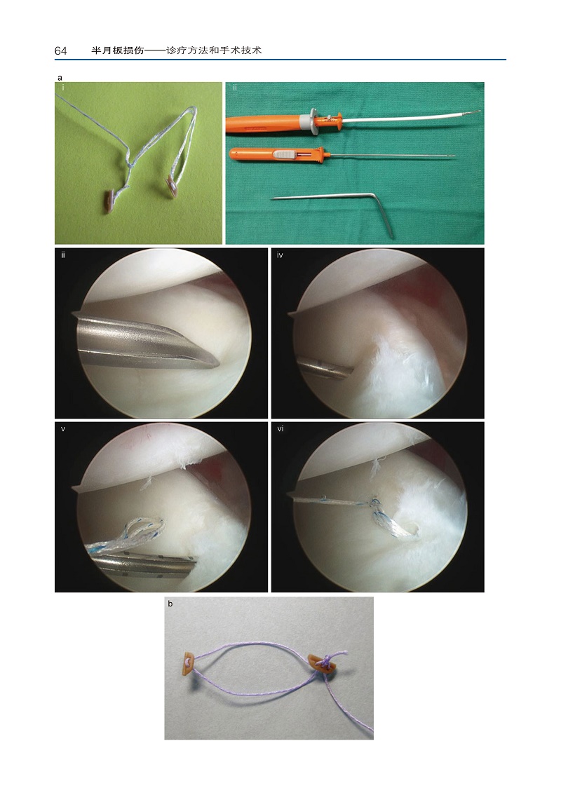半月板损伤诊疗方法与手术技术半月板修复增强技术半月板损伤诊疗原则
