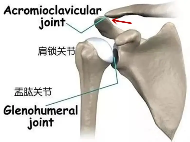 肩膀翘起来了是肩关节脱位 医生说是另外一个关节 骨科