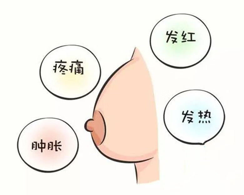 乳腺炎乳房疼痛 按摩就可以了 医生这么说 女性健康 外科