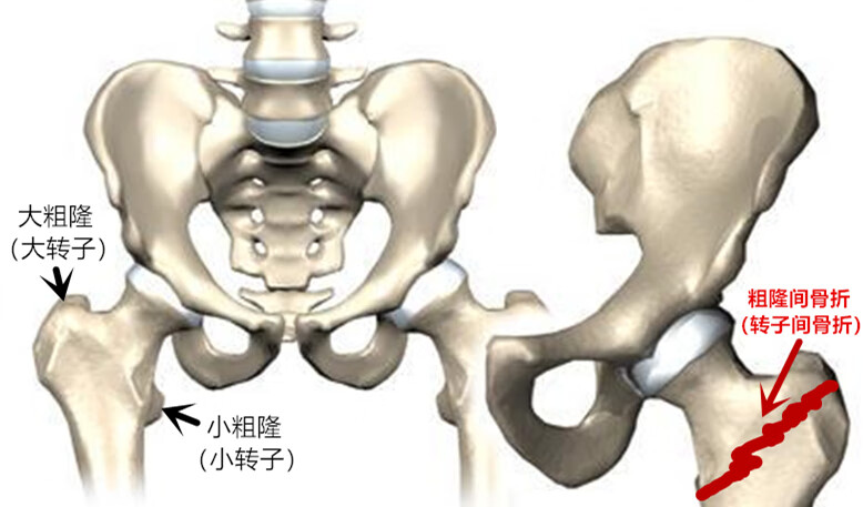 什么是股骨粗隆间骨折 有什么特点 为什么老人居多 骨科 关节 疼痛