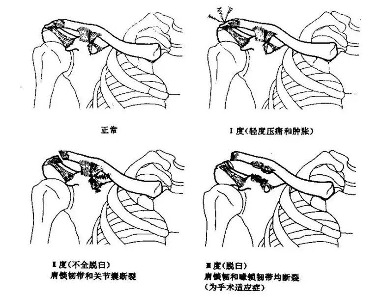 肩膀翘起来了是肩关节脱位 医生说是另外一个关节 骨科
