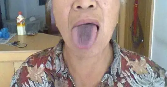 舌苔突然变黑 是不是人之将死 预防 中医 舌苔突然变黑 是不是人之将死 预防 中医