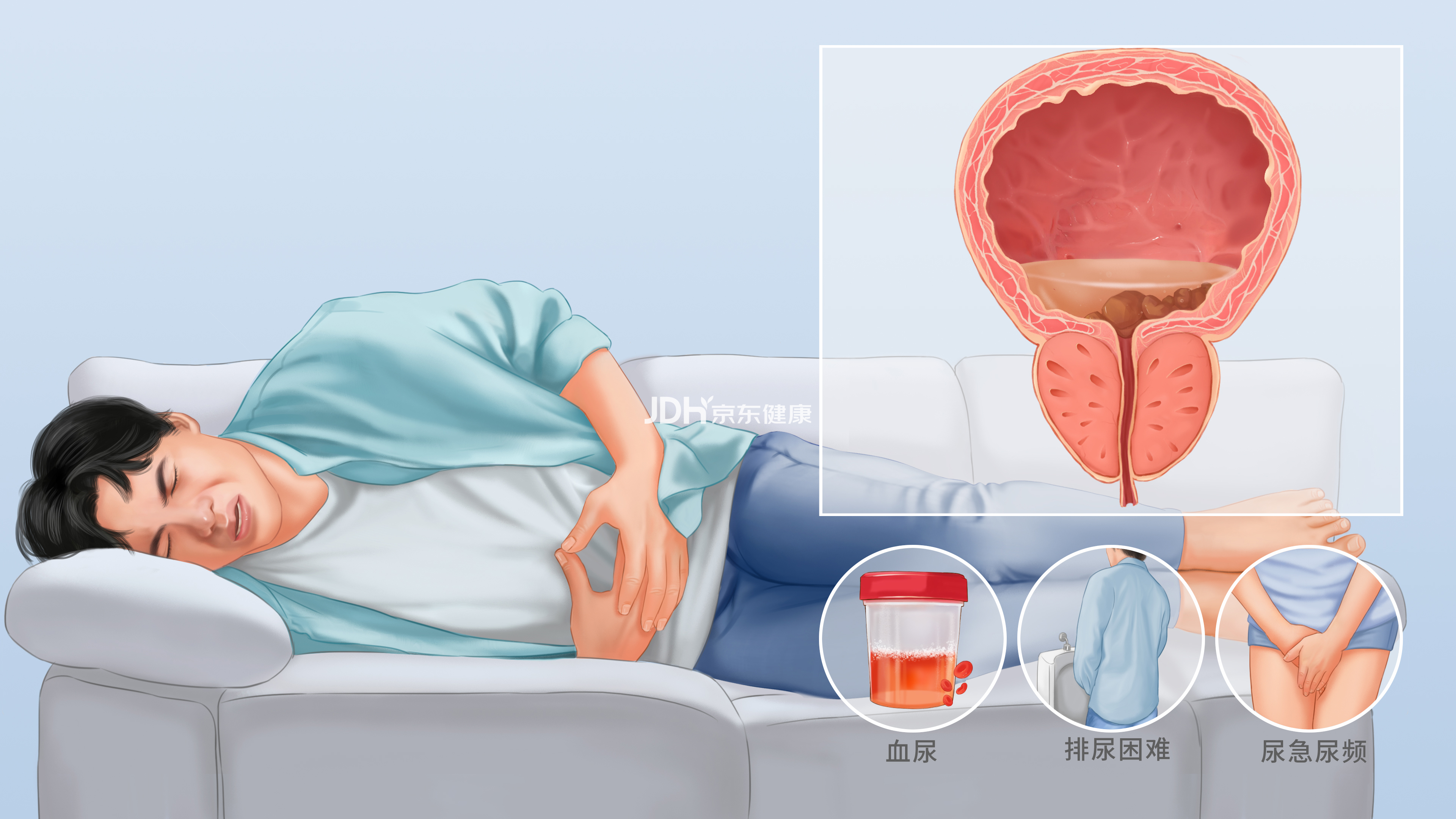 膀胱结石症状有哪些图片