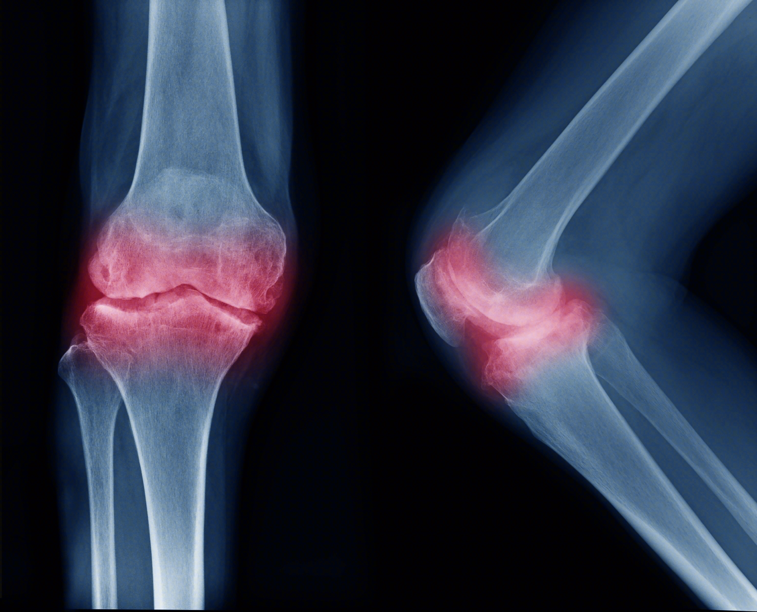 膝关节的结构特点与骨质增生、退型性变。_南通国光中医门诊部