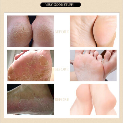 

Natural Herbal Baby Feet Exfoliating Anti-Drying Crack Foot Cream Foot Mask Effective Anti Fungal Dead Skin Feet Care