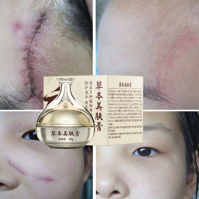 

Chinese Medicine Strong Facial Care Scar Treatment Surgery Burn Repair Scald Acne Cream Skin Care