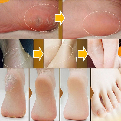 

Feet Care Anti Dry Crack Repair Cracked Heel Anti-inflammatory Foot Peeling Balm Exfoliating Foot Creams