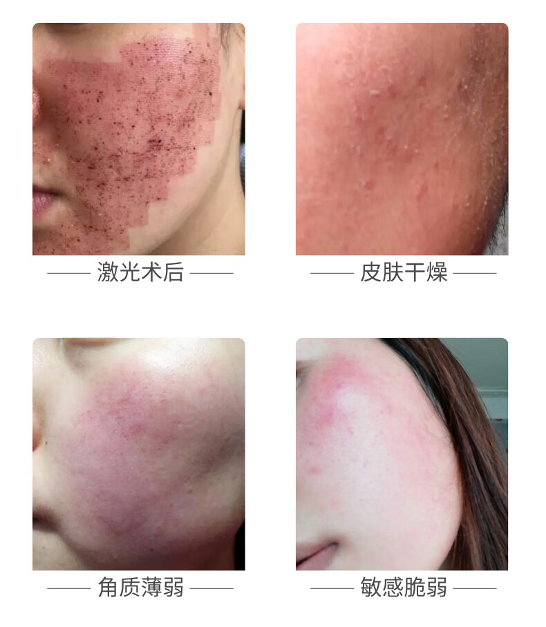 丽泊泉冻干粉修复医美激光术后护理祛痣斑舒缓脸颊泛红敏感皮肤生长因子