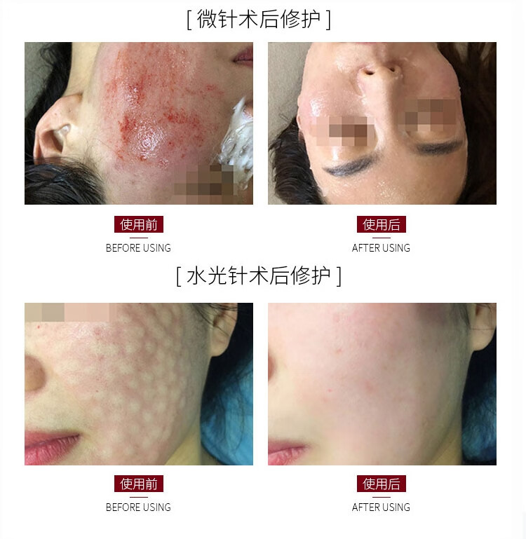 丽泊泉多肽修护冰晶舒缓敏感退红脸干痒脱皮透明质酸钠激光术后修复凝胶 白色50g