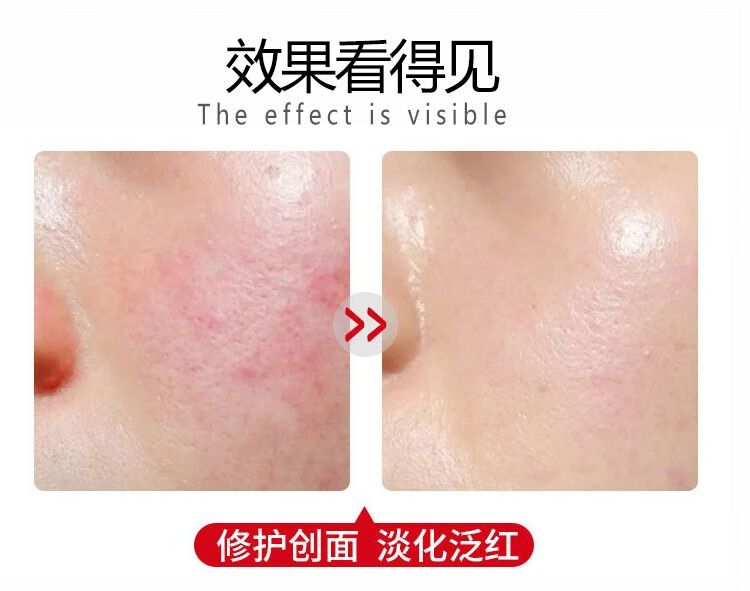 丽泊泉多肽修护冰晶舒缓敏感退红脸干痒脱皮透明质酸钠激光术后修复凝胶 白色50g