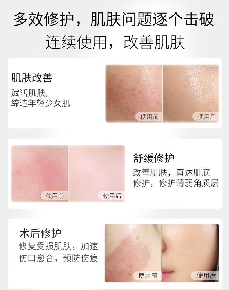 丽泊泉冻干粉修复医美激光术后护理祛痣斑舒缓脸颊泛红敏感皮肤生长因子