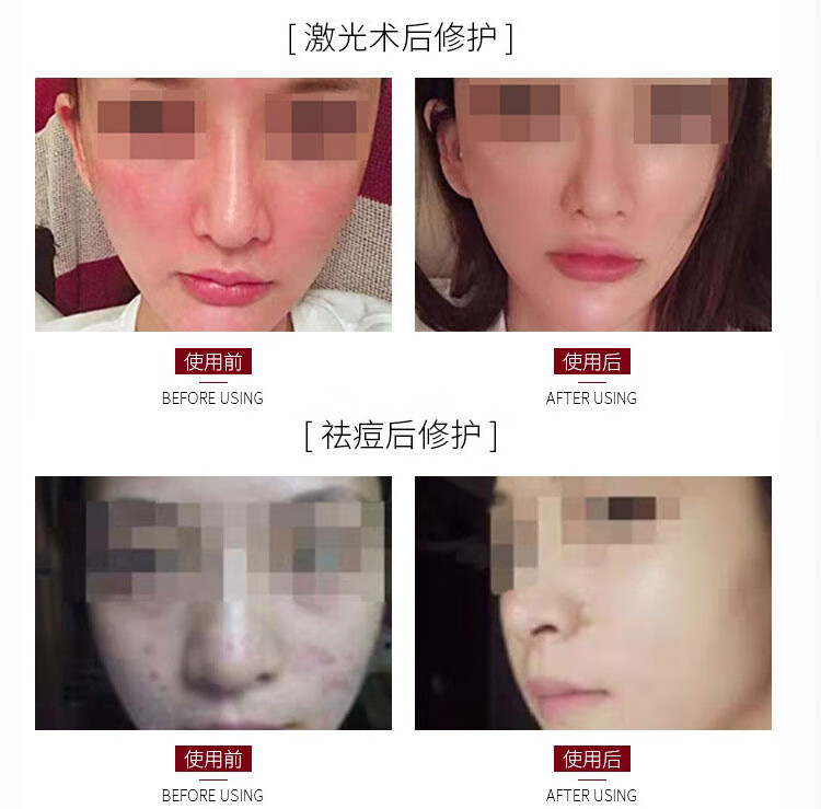 丽泊泉多肽修护冰晶舒缓敏感退红脸干痒脱皮透明质酸钠激光术后修复凝胶 白色50g