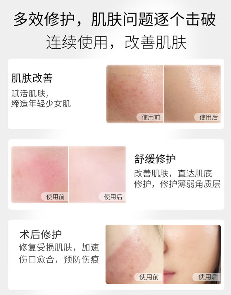 丽泊泉多肽修护冰晶舒缓敏感退红脸干痒脱皮透明质酸钠激光术后修复凝胶 白色50g