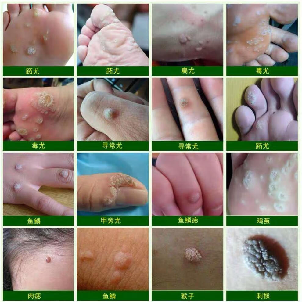 优瘊膏去脖子肉粒去猴子颈部赘皮扁平尤神器液瘊优偏方小瓶但实用1瓶