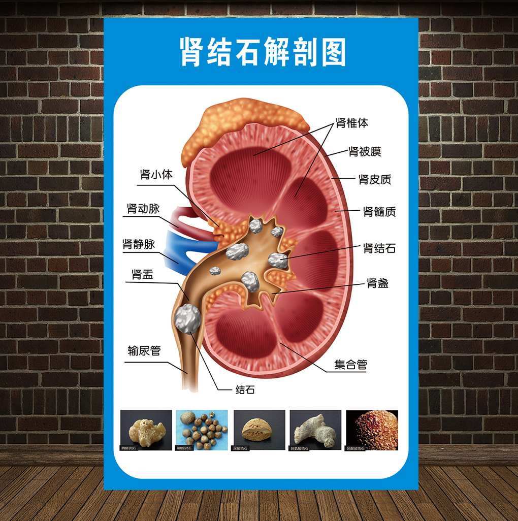 定制肾结石泌尿结石解剖图医学宣传挂图人体器官结构图医院海报墙贴纸