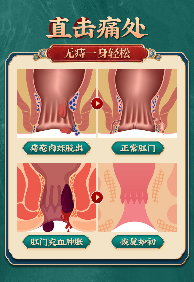 正常肛门痔疮图片