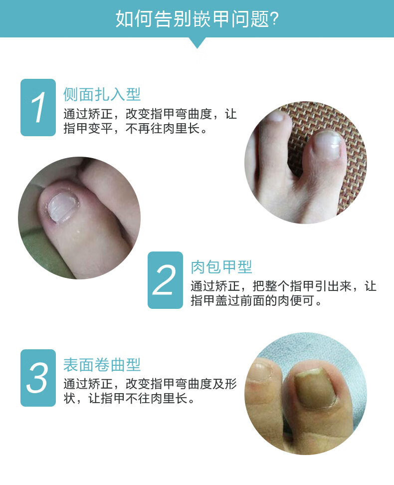 甲沟炎 正甲贴甲沟炎嵌甲矫正i器脚趾甲矫正贴片指甲 【德国技术】
