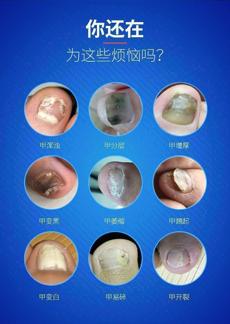 亮甲去除灰指甲专用药治灰甲净厚甲液 【3瓶 疗程装】【图片 价格