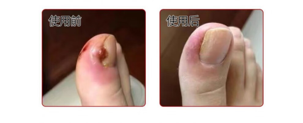 明泰3号三号治疗甲沟炎专用软化甲去肉芽消肿医生推荐款1盒装