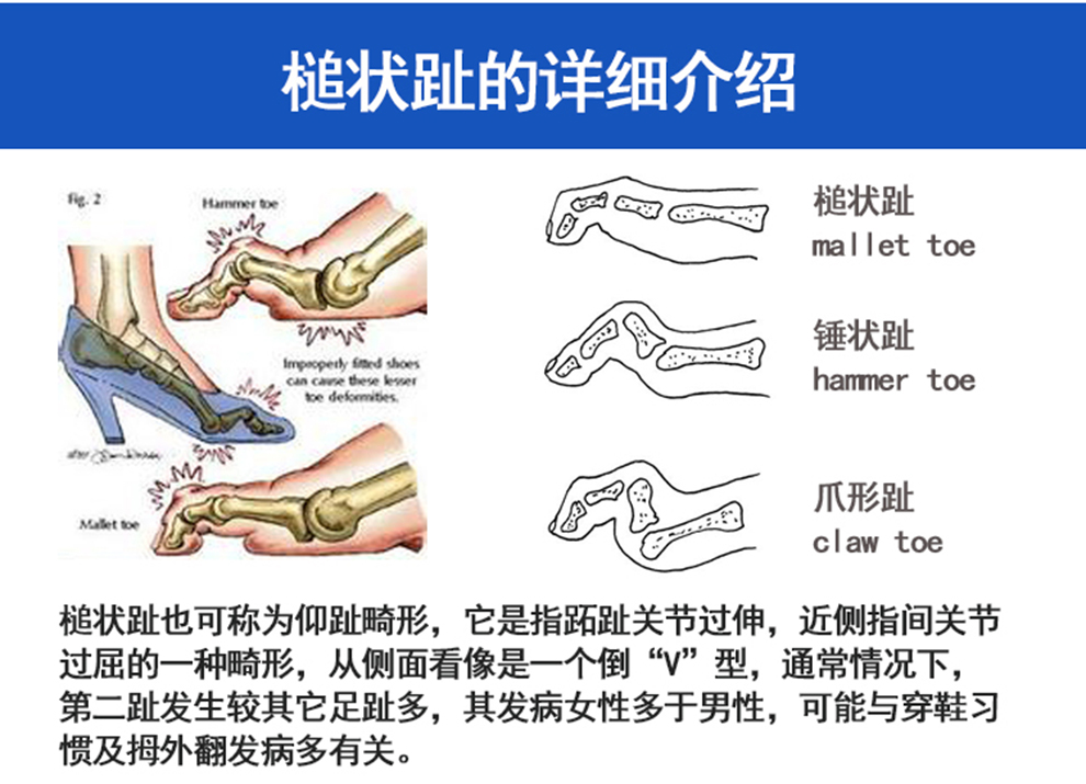 康立捷儿童成人脚趾弯曲矫正器槌状趾锤状趾爪形指纠正器拇外翻分趾器重叠脚趾变形矫正器弓起固定带分离器