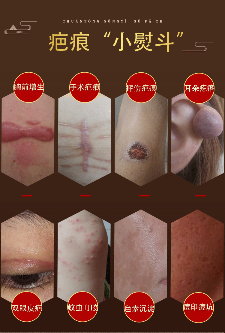 灵修复膏增生凸起手术旧伤疤贴沉淀疙瘩去除一抹消