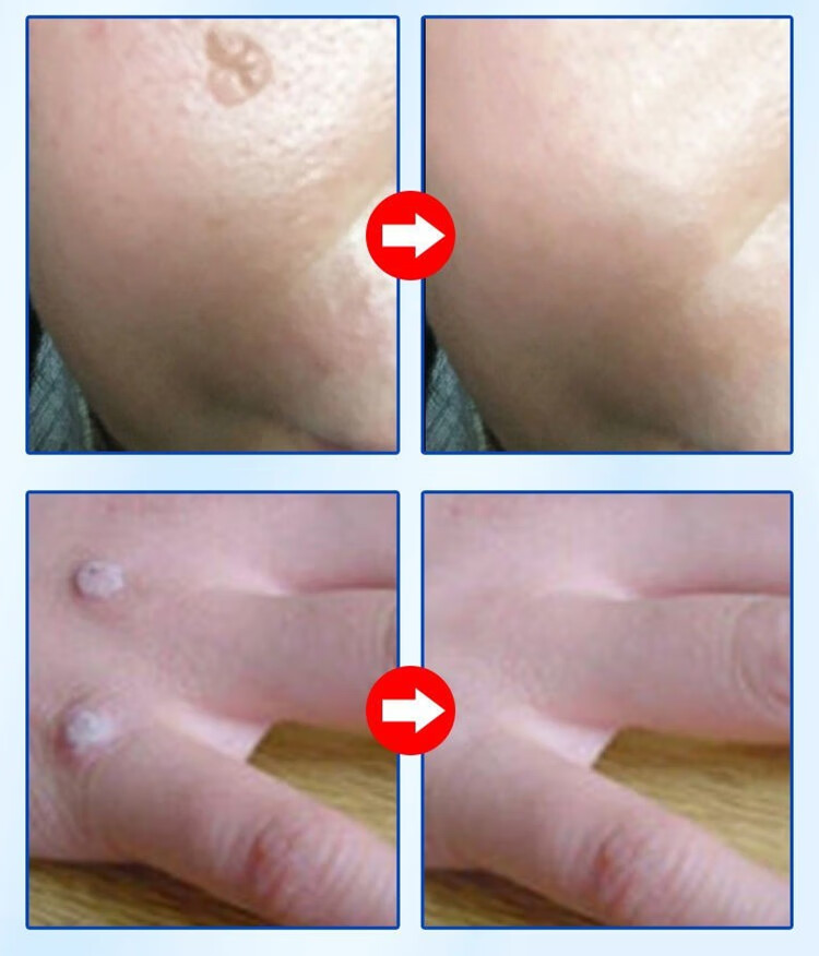 药房直售疣瘊净搭乳膏软膏氟尿嘧啶草本克尤膏去疣灵肉粒瘊猴子去克除