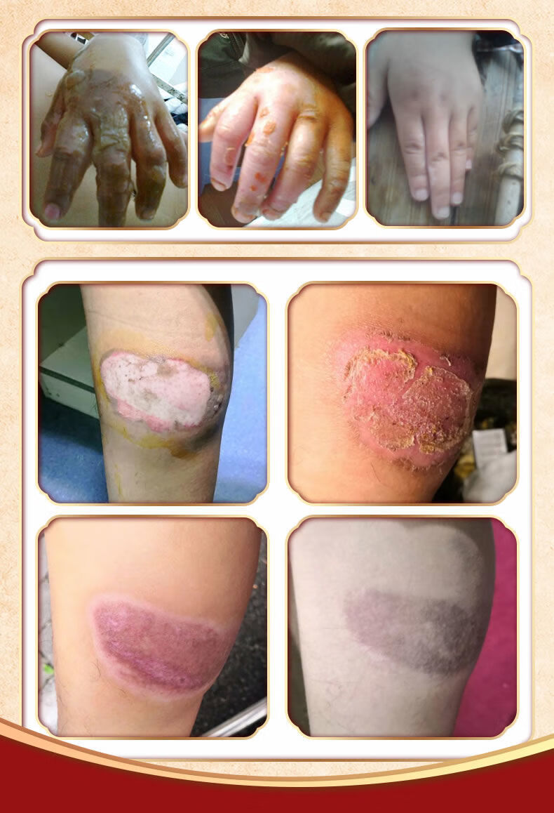 伟博紫草蛇油烧伤烫伤膏外用皮肤烧烫伤开水儿童獾子油水泡火湿润紫草